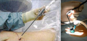 Endoskopische (perkutane) Operation